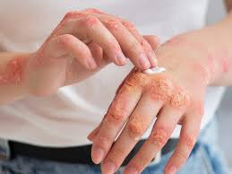 Mengenal Apa Itu Dermatitis Atopik